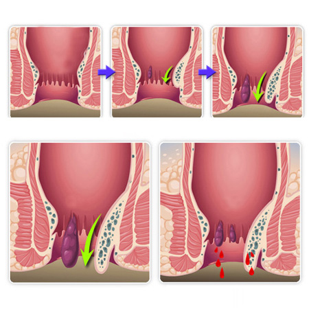 內(nèi)痔脫出怎么辦？