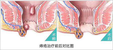 內(nèi)痔術(shù)前與術(shù)后對(duì)比圖